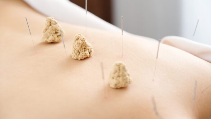 Acupuncture and moxibustion on the back of a woman in a bright acupuncture center Acupuncture and moxibustion on the back of a woman in a bright acupuncture center