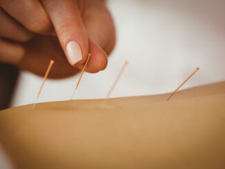 Young woman getting acupuncture treatment in therapy room