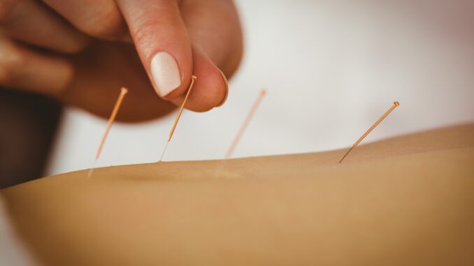 Young woman getting acupuncture treatment in therapy room Young woman getting acupuncture treatment in therapy room
